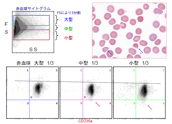 乖離症例における赤血球サイズによるCD55,59の染色性（A A）