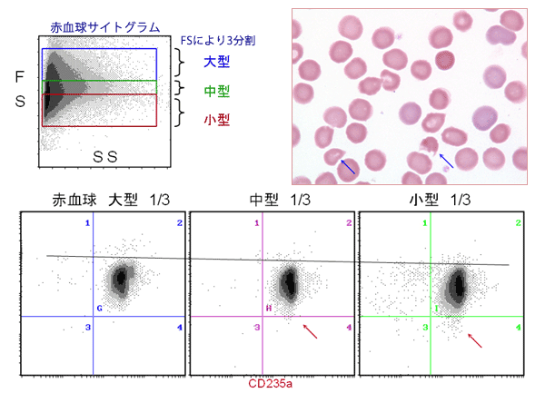 乖離症例における赤血球サイズによるCD55,59の染色性(A A)