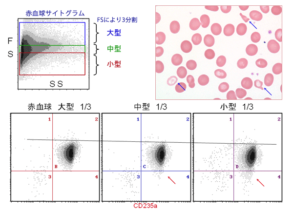 乖離症例における赤血球サイズによるCD55.59の染色性(MDS)