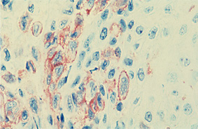 Histiocytosis X（AEC発色）