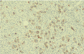 HRS4で染色した、Large anaplastic cell lymphoma （AEC発色）