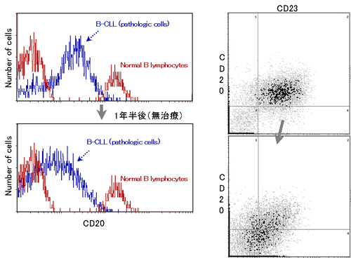 B-CLL症例におけるCD20発現量の変化