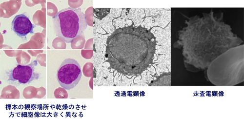 Hairy cell leukemia の 細胞像