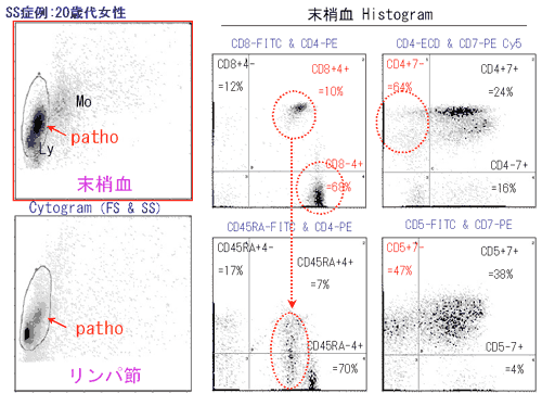 3 解析方法 3 フローサイトメーターによる悪性リンパ腫の解析 A To Z サイトメトリードットコム